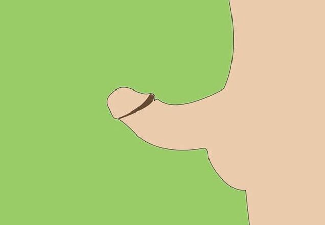 Cerrahi genişlemenin bir göstergesi olarak penisin eğriliği